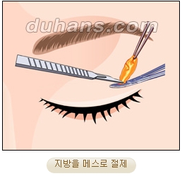 두한성형외과 지방제거 - 눈밑지방, 눈꺼풀지방제거 관련 이미지 7