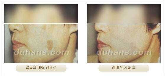 [두한성형외과 경쟁력 안전성형] - [최첨단 장비를 이용한 흉터, 점, 주근깨, 잡티, 문신제거 레이저 시술] 관련 이미지 20