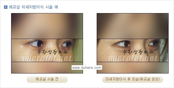 [두한성형외과 경쟁력 눈밑성형] - [눈밑 다크써클과 눈밑 애교살과의 관계 1.] 관련 이미지 4
