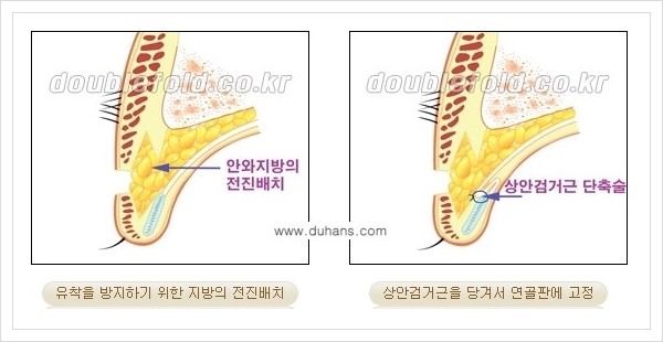 [두한성형외과 경﻿쟁력 눈성형] - [안검하수(졸린눈매) 종류와 교정 수술 안내] 관련 이미지 10