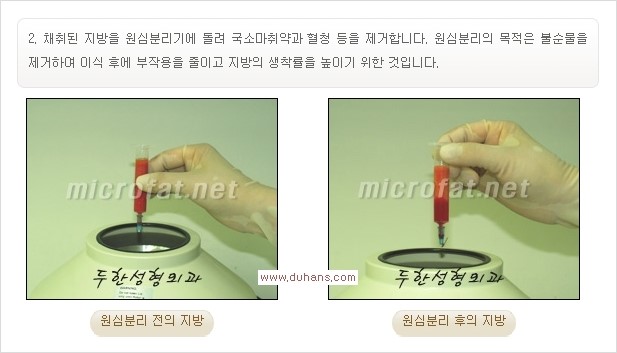 [두한성형외과 경쟁력 미세지방이식] - [입술 3차원 입체지방이식 안내 1.] 관련 이미지 5
