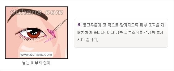 [두한성형외과 NO.1 눈성형] - [몽고주름 제거(앞트임 수술) 2.] 관련 이미지 7