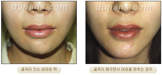 [Duhan Plastic Surgery Micro Fat Grafting] - [Receded Chin, Small Chin, Cleft Chin, Chin Line Asymmetry Correction] image 2