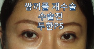 [두한성형외과-쌍꺼풀 재수술] #인아웃라인#쌍꺼풀재수술 관련 이미지 1