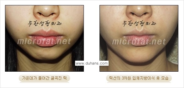 [두한성형외과의 경쟁력 미세지방이식] - [무턱교정 - 턱 미세지방이식 안내 2.] 관련 이미지 13