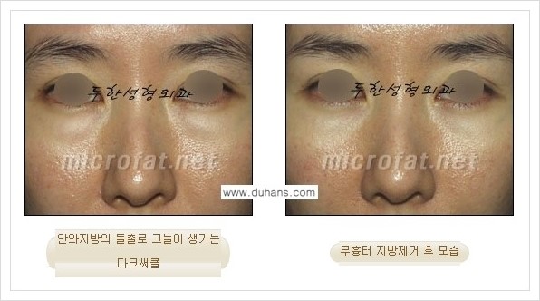[두한성형외과 경쟁력 눈밑성형] - [눈밑지방제거, 눈위지방제거 안내 2.] 관련 이미지 1