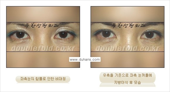 [두한성형외과 NO.1 눈성형] - [함몰된(꺼진) 눈꺼풀에서 쌍꺼풀 라인 교정 3.] 관련 이미지 6