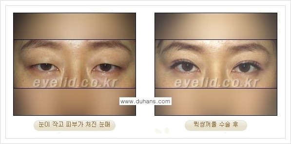 [두한성형외과 경쟁력 눈성형] - [퀵쌍꺼풀 수술] 관련 이미지 10