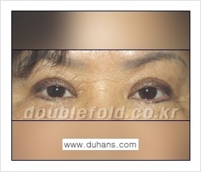 [두한성형외과] - [쌍꺼풀 재수술의 대상과 그에 대한 쌍꺼풀 재수술 방법 안내] 관련 이미지 1