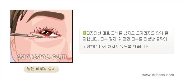 [두한성형외과 경쟁력 다크써클 교정] - [젊어 보이면서 개선된 인상을 주는 하안검 성형술] 관련 이미지 9