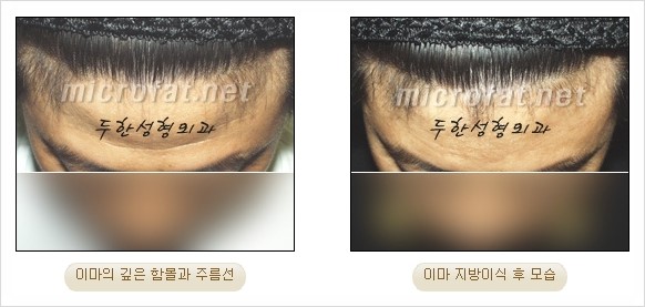 [두한성형외과 경쟁력 지방이식 리더] - [Col-fat(콜펫)지방이식, 3차원 입체지방이식, 2차원 평면지방이식] 관련 이미지 69