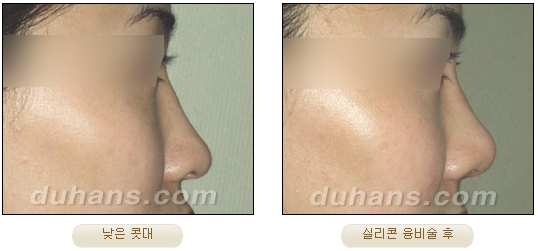 [두한성형외과 코성형] - [코재수술 방법] 관련 이미지 30