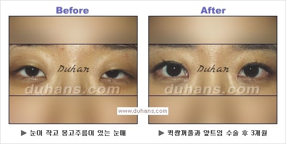 ​[두한성형외과 경쟁력 눈성형] - [자연스러운면서 매력적인 쌍꺼풀 퀵 쌍꺼풀 수술 안내] 관련 이미지 18