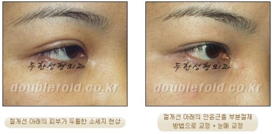 [Duhan Plastic Surgery Double Eyelid Revision Surgery] - [Ptosis, sausage eyelids] image 27