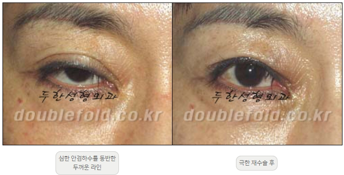 [Double Eyelid Surgery, Duhan Plastic Surgery] - [Extreme Revision Eye Surgery to Correct a Damaged Line] image 7