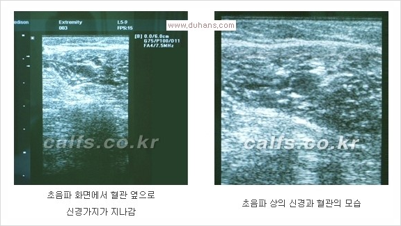 ⁠⁠[두한성형외과 경쟁력 종아리성형] - [굵은 다리의 모양과 원인에 따른 종아리성형 방법] 관련 이미지 8
