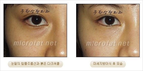 [두한성형외과 경쟁력 눈밑성형 리더] - [윗눈꺼풀 지방제거, 눈밑지방제거, 눈밑지방재배치, 눈밑지방이식 안내] 관련 이미지 23