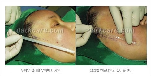 [두한성형외과 경쟁력 주름성형] - [주름제거를 위한 리프팅] 관련 이미지 19