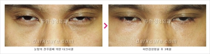 두한성형외과 눈밑수술 - 다크서클 수술 전후 관리 안내 관련 이미지 85