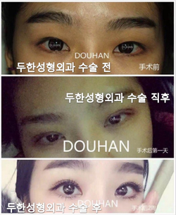 [DuHan Plastic Surgery Eye Surgery] - [Guide to Epicanthoplasty and Canthoplasty for Increasing the Horizontal Width of the Eyes] image 45