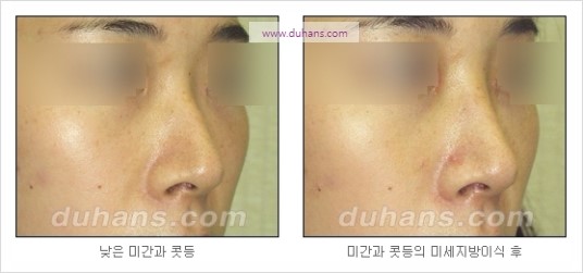 [두한성형외과 경쟁력 코성형] - [코를 높히는 지방이식] 관련 이미지 11