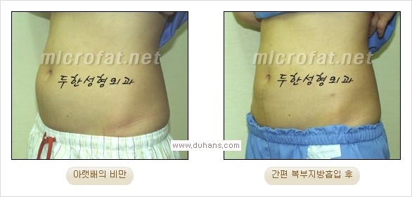 [두한성형외과 경쟁력 지방흡입] - [초음파 지방흡입과 미세흡입관을 이용한 간편지방흡입] 관련 이미지 15