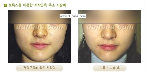 [두한성형외과 각진 얼굴을 갸름한 얼굴형으로의 변신] - [사각턱 보톡스] 관련 이미지 8