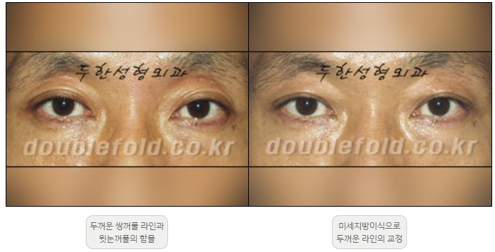 [Duhan Plastic Surgery Double Eyelid Revision] - [Thick Double Eyelid Line] image 18