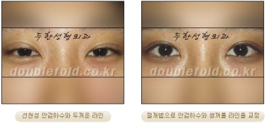 [Duhan Plastic Surgery Double Eyelid Revision Surgery] - [Ptosis, sausage eyelids] image 15