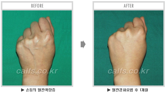 [종아리성형 두한성형외과] - [종아리수술에 대한 자주하는 질문과 답변 모음] 관련 이미지 32