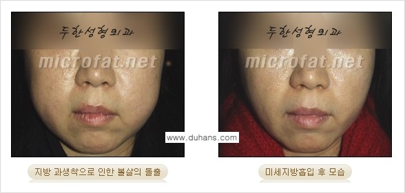 [두한성형외과 경쟁력 미세지방이식] - [미세지방이식 부작용 종류와 교정방법 안내] 관련 이미지 10