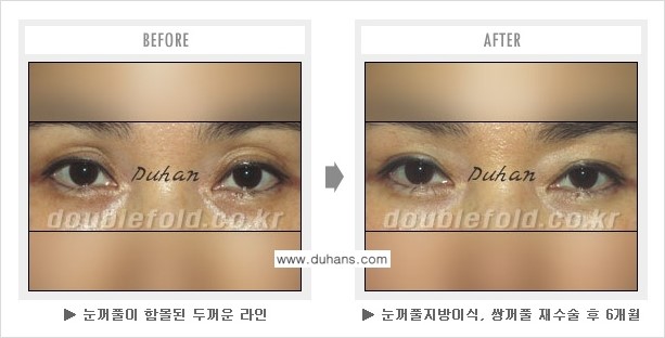 [두한성형외과 NO.1 쌍꺼풀 재수술, 극한 재수술] - [안검하수 교정이 불가능할 경우의 문제점 해결 안내] 관련 이미지 6