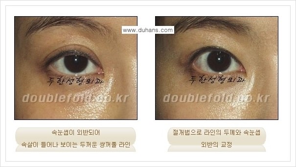 [두한성형외과 경쟁력 쌍꺼풀 재수술, 극한 재수술] - [망가진 눈 복원수술 - 속눈썹 외반 교정 안내] 관련 이미지 3