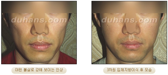[두한성형외과 얼굴자가지방이식] - [볼살, 이마, 측두부] 관련 이미지 32