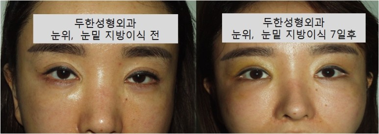 [두한성형외과] - [눈두덩이지방이식, 눈꺼풀지방이식, 눈밑지방이식, 다크서클, 다크써클] 관련 이미지 2