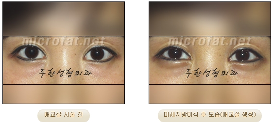 ​[두한성형외과 지방이식] - [애교살] 관련 이미지 19