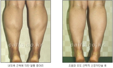 ​[두한성형외과 종아리수술] - [나에게 맞는 종아리성형방법] 관련 이미지 14