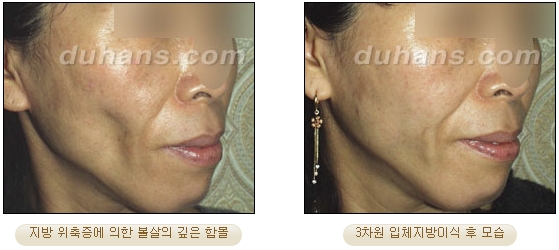 [두한성형외과 얼굴자가지방이식] - [볼살, 이마, 측두부] 관련 이미지 25