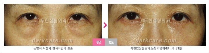​[두한성형외과 경쟁력 눈밑성형 리더] - [눈밑 다크써클의 증상, 원인, 종류, 치료방법 안내] 관련 이미지 72