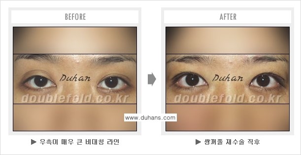 [두한성형외과 쌍꺼풀 재수술] - [피부 여유분이 부족해서 토안증이 발생한 경우] 관련 이미지 3