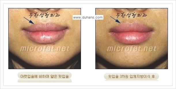 [두한성형외과 경쟁력 미세지방이식] - [입술 미세지방이식 안내 2.] 관련 이미지 4