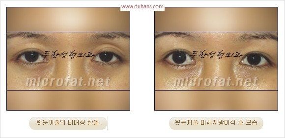 [두한성형외과 경쟁력 눈성형 리더] - [윗눈꺼풀 함몰( #꺼진눈꺼풀) 미세지방이식과 상안검성형]#꺼진눈성형 , #눈위함몰 관련 이미지 24