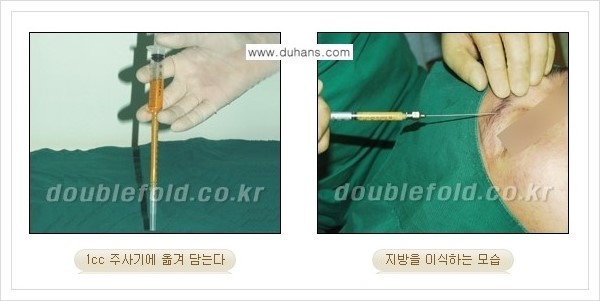 [두한성형외과 경쟁력 눈성형] - [미세지방이식으로 두껍고 어색한 라인 교정 안내 1.] 관련 이미지 3