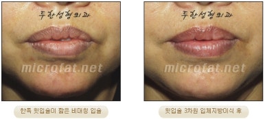 [두한성형외과 입술성형] - [볼륨감 있는 입술 미세지방이식] 관련 이미지 25