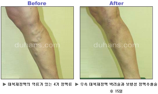 [두한성형외과 정맥류] - [하지정맥류, 정맥확장증, 혈관확장증] 관련 이미지 38