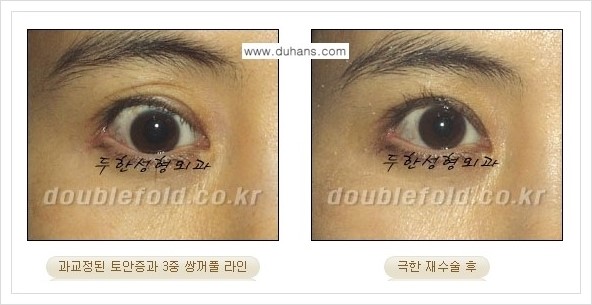 [두한성형외과 경쟁력 쌍꺼풀 재수술, 극한 재수술] - [망친 눈(쌍꺼풀) 복원수술과 일반 쌍꺼풀 재수술과의 차이점] 관련 이미지 11