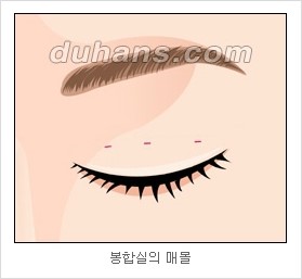 [두한성형외과 경쟁력 눈성형 리더] - [아름다운 눈매를 위한 쌍꺼풀 수술 안내] 관련 이미지 11