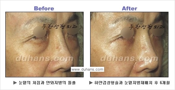 [두한성형외과의 상큼하고 환한 젊은 눈매완성] - [하안검 성형술 ②] 관련 이미지 3