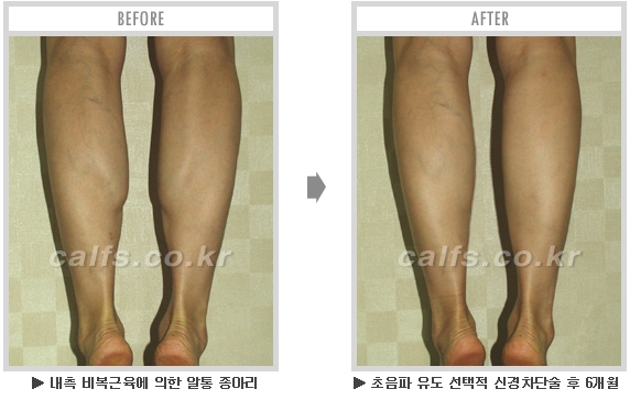 [종아리성형 두한성형외과] - [종아리수술에 대한 자주하는 질문과 답변 모음] 관련 이미지 69