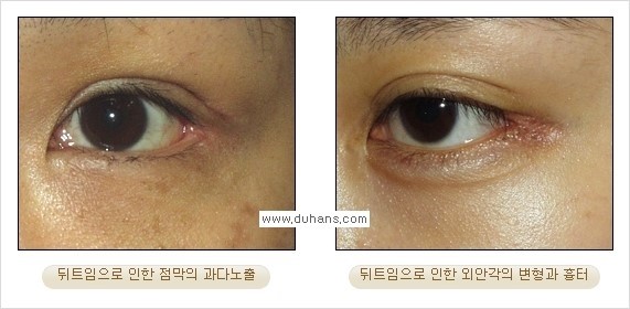 [두한성형외과 경쟁력 쌍꺼풀 재수술, 극한 눈재수술] - [뒤트임 수술의 부작용 안내] 관련 이미지 1